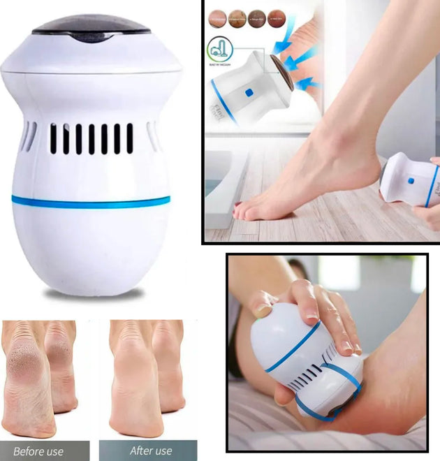 Callus Remover